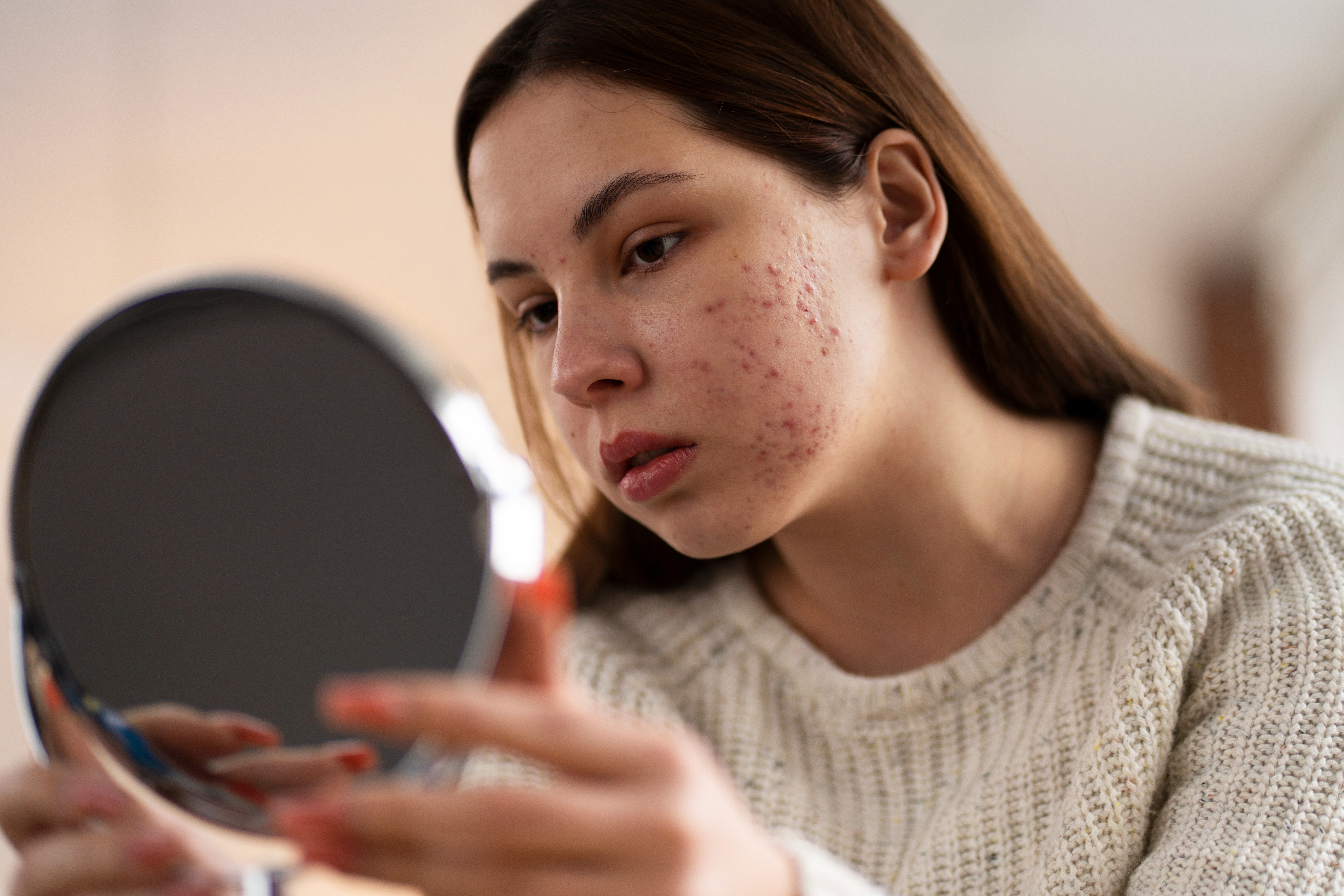 pele-com-acne-espinhas Garota com pele acneica olhando no espelho
