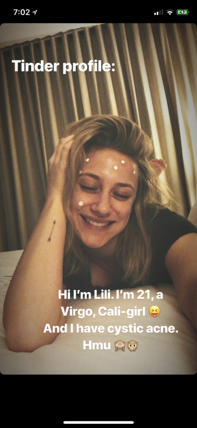 lili-reinhart-acne