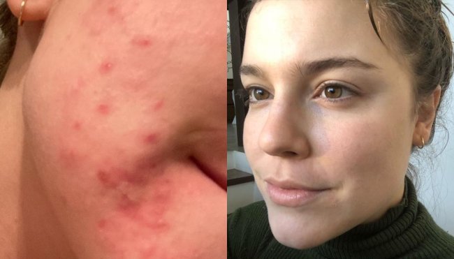 alice-wegmann-acne Alice Wegmann