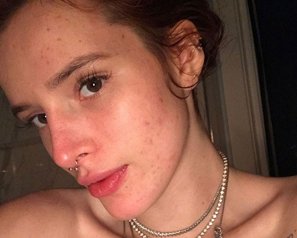 famosas-que-falam-sobre-acne-espinhas-bella-thorne